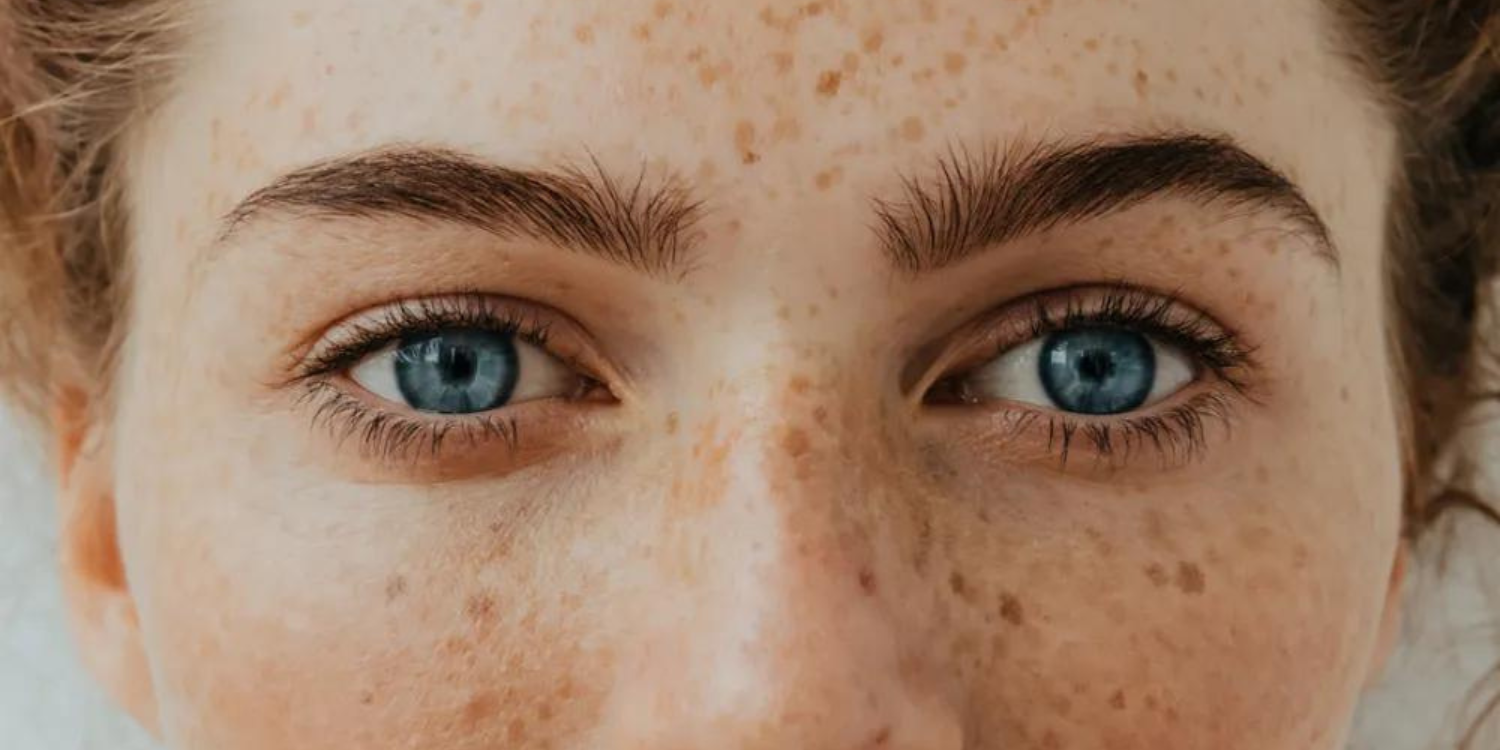 Why Do So Many People Have the Same Freckle?